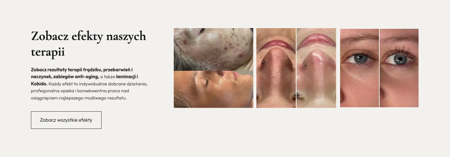 Estetic Skin 6 Estetic Skin — Zobacz efekty naszych terapii